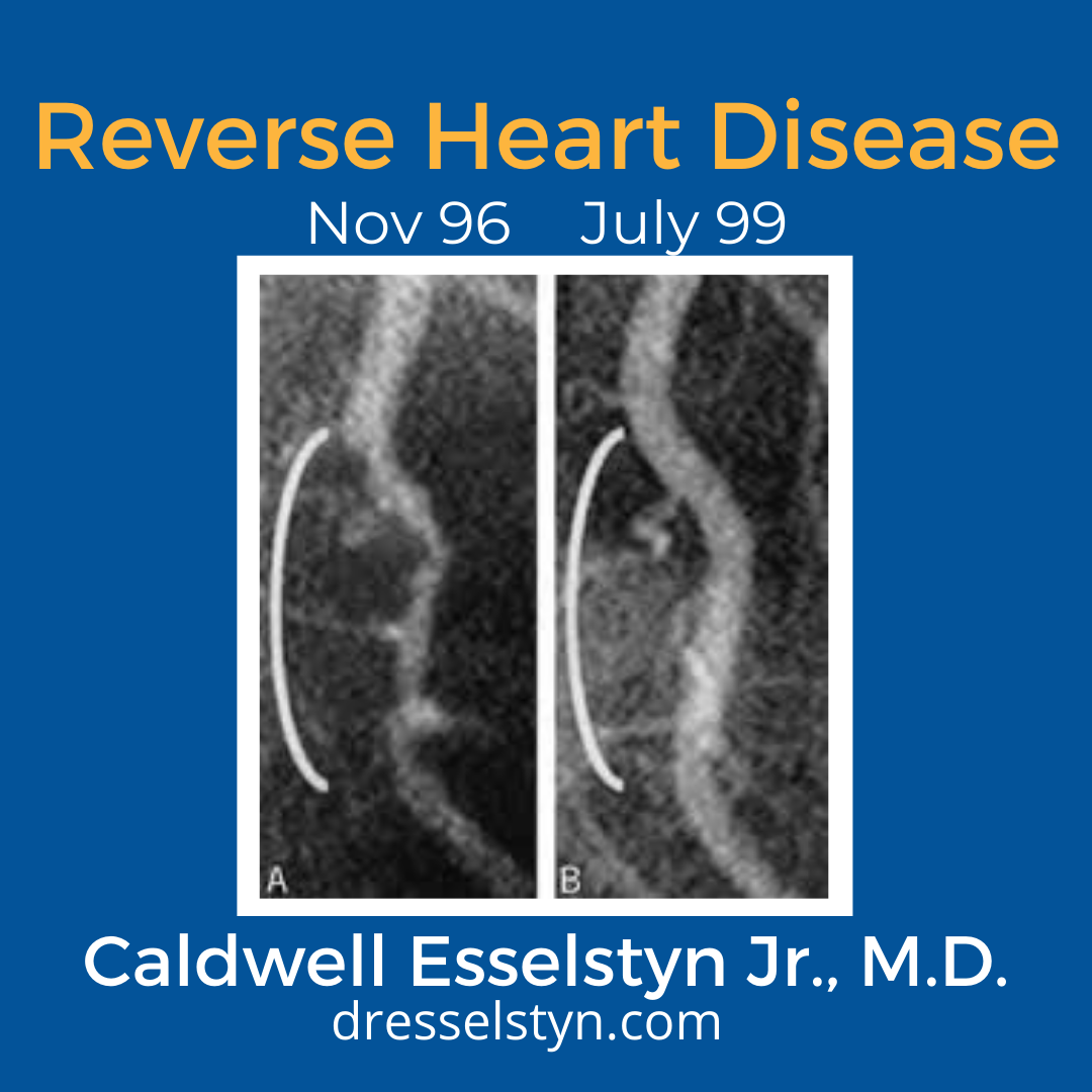 Photo taken by Dr. Caldwell Esselstyn Jr., M.D. of a before and after images of heart catheterization x rays from 1996 to 1999 showing improved coronary blood flow and proving heart disease reversal with a plant based diet